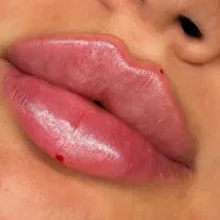 بوتاکس ،جوانساز ،لب روسی ،فول فیس ،فیلر