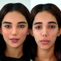 فیلر، ژل ، بوتاکس ،PRP، آنزیم