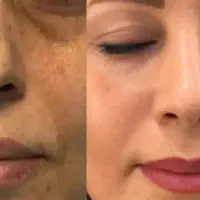 بهبود لک و چروک وارداتی