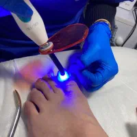جذب مدل زگیل کف پا،میخچه،قارچ و ناخن فرو رفته