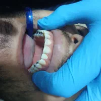 ساخت دندان قیمت محلات