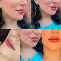 بوتاکس/فیلربادی/ژل لب/زاویه فک/پی آر پی مو و ابرو