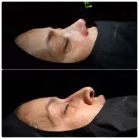 جراحی بینی با مشاوره رایگان