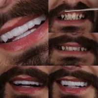 کامپوزیت دندان .لمینت