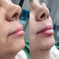 آموزش فیلر،بوتاکس،نخ،لیزر،فیشال توسط پزشک