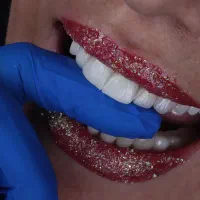 لمینت دندان و کامپوزیت تخصصی اقساطی کاملا دیجیتال