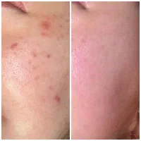فیشال،پاکسازی پوست،لیزر بدن،لیزر جای زخم