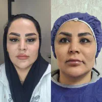 بلفارو(جراحی پلک) فقط ۷.۹۹۰