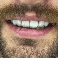 دندانپزشکی (کامپوزیت،عصب کشی،ترمیم)