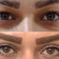 تخفیف ویژه محرم بلفاروپلاستی چشم هشت میلیون