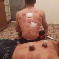 حجامت بادکش گرم کل تهران . ری