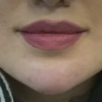 تزریق بوتاکس