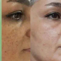 ضدجوش|آرایشی، بهداشتی، درمانی|تهران, نعمت‌آباد|دیوار