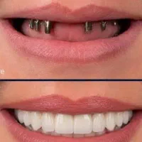 ایمپلنت دیجیتال یک روزه اقساط دو ساله بدون سود
