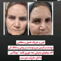 درمان چین و چروک|خدمات آرایشگری و زیبایی|جوادآباد, |دیوار