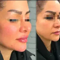 تخفیف فیلر تزریق ژل و بوتاکس