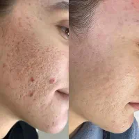 رفع جوش و جای جوش چاله و چوله