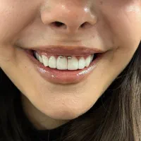 اجرای انواع پیرسینگ و میکرودمال