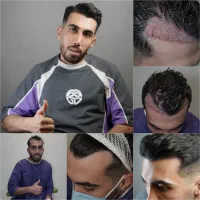 کلینیک کاشت مو و ابرو