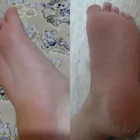 رفتن ترک پا با اسپری نانونقره