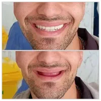 دندان مصنوعی ( بدون۱ریال سود/۳الی۸ماهه/پذیرش بیمه)