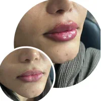 ژل وبوتاکس
