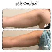 جشنواره اندولیفت،هایفو،نخ مایع وفیلر جوانسازی،لیفت