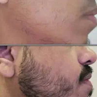 رویش مجدد ریش در ۲۵ روز