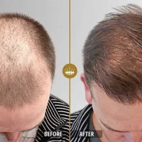 کاشت مو|خدمات آرایشگری و زیبایی|خوی, |دیوار
