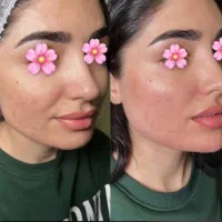 ژل بوتاکس کلیه خدمات مطب ۸۰ درصد آف