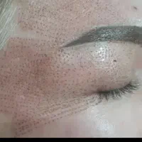 حذف چروک و کوچک کردن بینی