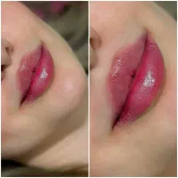 آمورش بوتاکس و ژل  ومزوتراپی  صورت