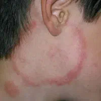 درمان قارچ پوستی با لیزر