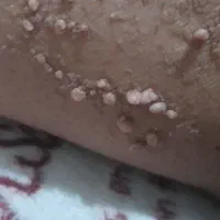 درمان ریشه ای زگیل و تبخال