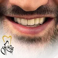 دندانپزشکی دیجیتال ایمپلنت اقساطی