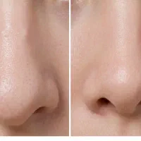 تغییر فرم بینی بدون جراحی قبل و بعد
