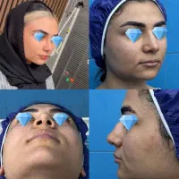 آف رینوپلاستی و لیپوماتیک بینی اهواز