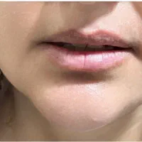 تزریق فیلر در مطب