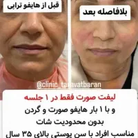 هایفو۷و۱۲بعد/حجمسینهباسن/پیآرپی/لیزرموهای زائد