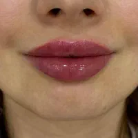 بهترین خدمات زیبایی ژل بوتاکس فیلر مزوژل لیزر