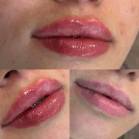 لاغری موضعی با کرایو/فیلر و بوتاکس/لیزر رولی/هایفو