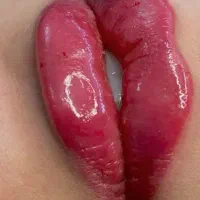 فیلر بوتاکس فیلربادی توسط پزشک