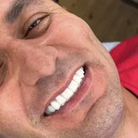 کامپوزیت/لمینیت بدون تراش بااقساط ویژه