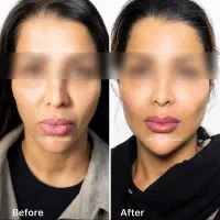 ژل و بوتاکس(تزریق توسط پزشک)