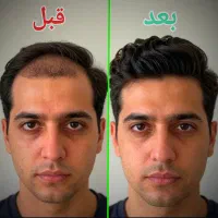 پروتز مو جلوی سر با ظاهری طبیعی