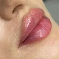 تزریق ژل .بوتاکس .انزیم بینی .مزوژل جوانساز