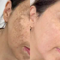 رفع تیرگی و لک صورت مزوتراپی مزوژل