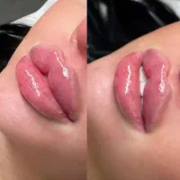 خدمات ژل و بوتاکس و انزیم