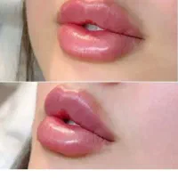ژل .بوتاکس .فیلربادی.جراحیهای زیبایی