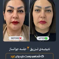 تزریق جوانساز،مزوژل پروفایلو ۱۰ میلیون